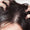 Dandruff